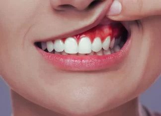 ¿Gingivitis o encías sensibles? Guía para diferenciarlas y cuidarlas gingivitis o encias sensibles