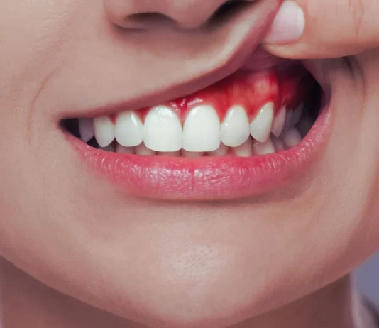 ¿Gingivitis o encías sensibles? Guía para diferenciarlas y cuidarlas gingivitis o encias sensibles