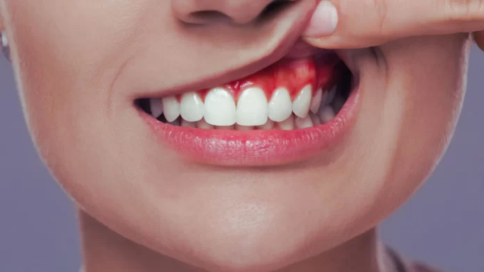 gingivitis o encias sensibles