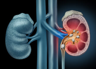 Cálculos renales: síntomas, causas y prevención para cuidar tu salud prevenir calculos renales a tiempo