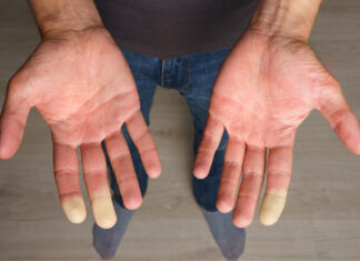 Diagnóstico precoz de la esclerosis múltiple: un avance decisivo para frenar la enfermedad