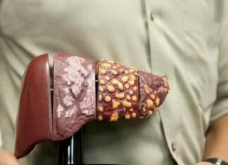 Hígado graso metabólico: la enfermedad silenciosa que amenaza la salud global