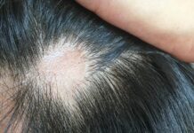 ¿Qué significa perder mucho cabello? Lo que dicen los expertos sobre un síntoma que va más allá de la estética