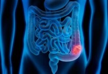 Sangrado rectal y cáncer de colon: la señal que los adultos jóvenes no deben ignorar