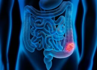 Sangrado rectal y cáncer de colon: la señal que los adultos jóvenes no deben ignorar