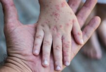 Aviso Epidemiológico de Sarampión en México