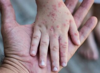 Aviso Epidemiológico de Sarampión en México