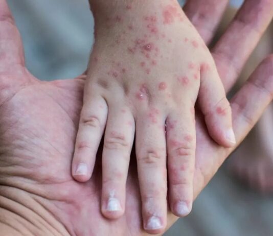 Aviso Epidemiológico de Sarampión en México