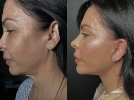 Recuperación acelerada: el nuevo lujo silencioso en la cirugía plástica el nuevo lujo silencioso en la cirugía plástica