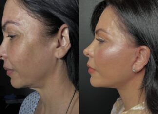 Recuperación acelerada: el nuevo lujo silencioso en la cirugía plástica el nuevo lujo silencioso en la cirugía plástica