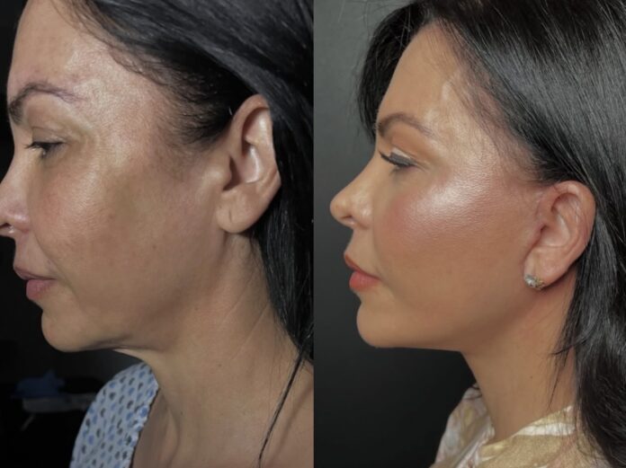 el nuevo lujo silencioso en la cirugía plástica