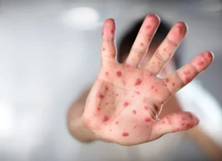 Sarampión en alerta: autoridades anticipan repunte de contagios y refuerzan llamado a vacunación incremento sarampion mexico