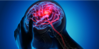 Infarto cerebral en jóvenes: casos aumentan y alertan sobre factores de riesgo en México