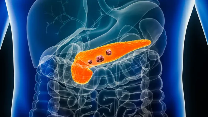 IA cancer pancreas