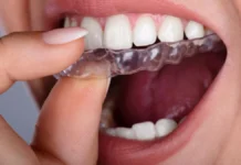 Alineadores invisibles revolucionan la salud dental y la estética facial alineadores en belleza