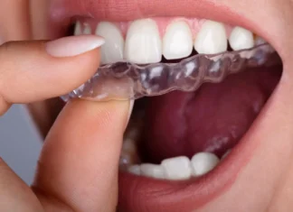 Alineadores invisibles revolucionan la salud dental y la estética facial alineadores en belleza