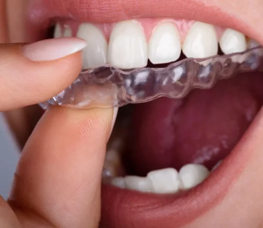 Alineadores invisibles revolucionan la salud dental y la estética facial alineadores en belleza