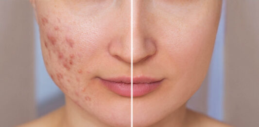 Cómo prevenir el acné con una rutina regular Cómo prevenir el acné con una rutina regular