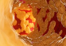 Arterias obstruidas: 10 señales de alerta que pueden advertir problemas cardiovasculares arterias obstruidas